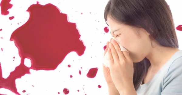 ฝันว่าเลือดออกจมูกเยอะมาก-"Dreamed that your nose was bleeding a lot."