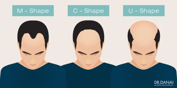 ฝันว่าหัวล้าน-"Dreaming of being bald"