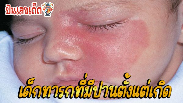 เด็กทารกที่เกิดมาแล้วมีปาน-"Babies born with birthmarks"